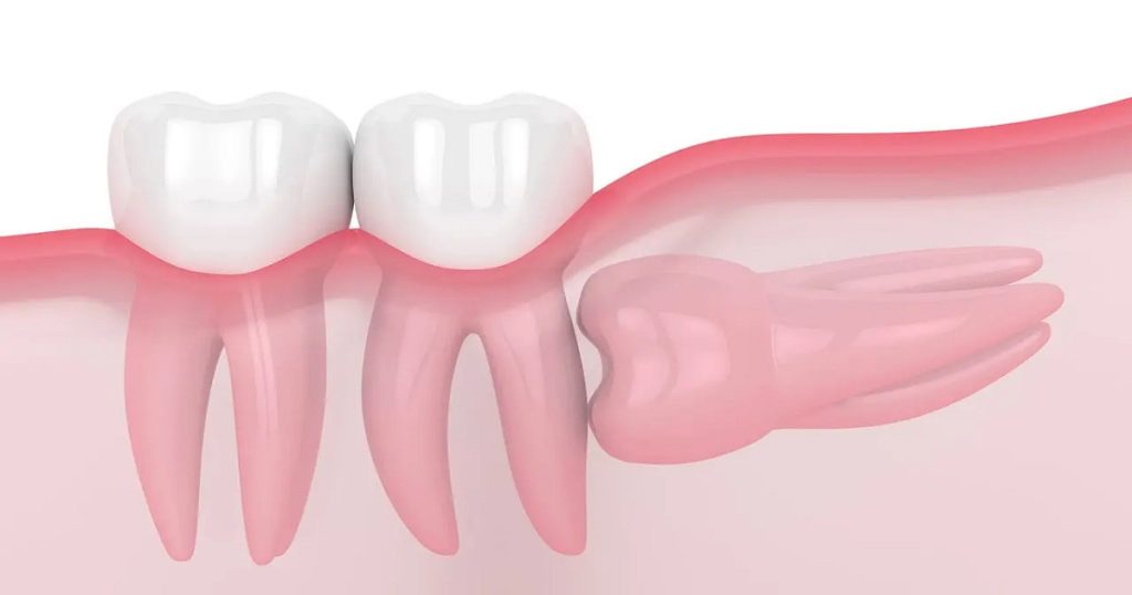 دندان های عقل و تهدیدی برای سلامت دندانها