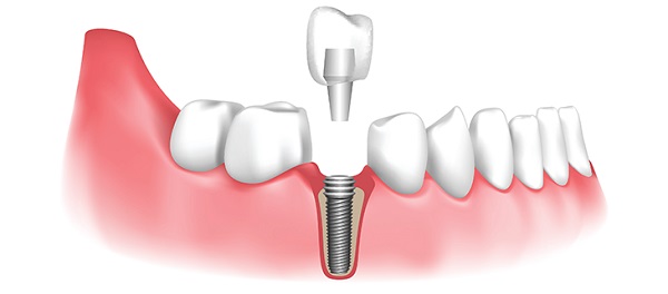ایمپلنت دندان کاشت دندان جایگزین دندان از دست رفته جایگزین دندان از بین رفته 
