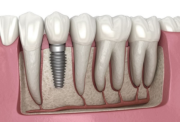ایمپلنت دندان کاشت دندان جایگزین دندان از دست رفته جایگزین دندان از بین رفته 