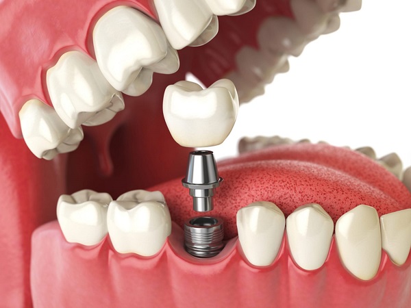 ایمپلنت دندان کاشت دندان جایگزین دندان از دست رفته جایگزین دندان از بین رفته