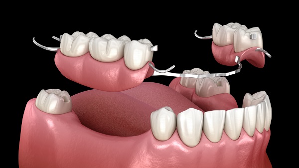 پروتز ثابت دندان پروتز متحرک دندان پارسیل اوردنچر روکش دندان 